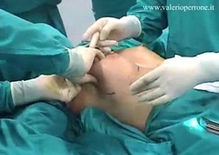 ,Breast Adding up transaxillary, prima e dopo, mastoplastica additiva per via ascellare - YouTube